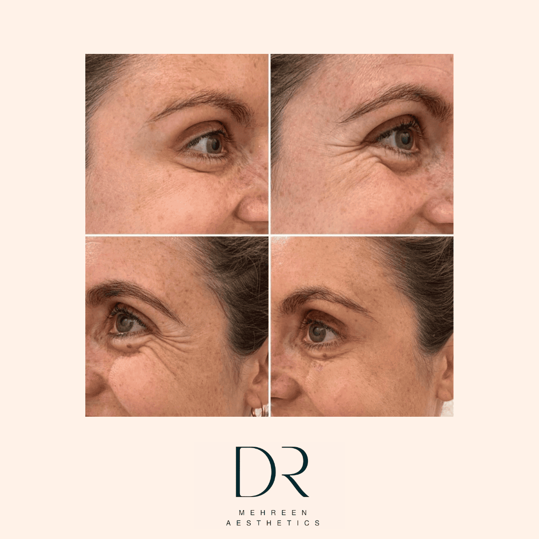 Antiwrinkle1