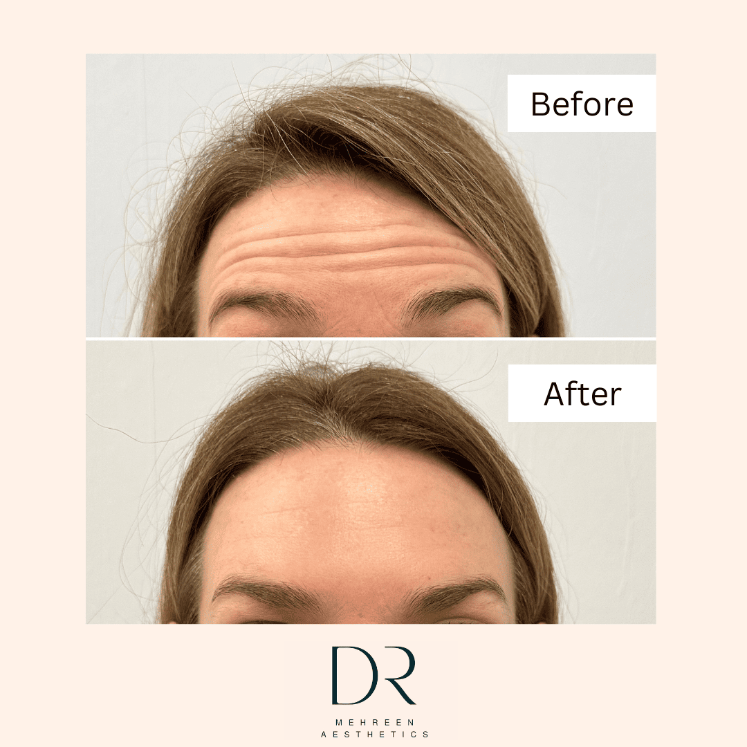 Antiwrinkle2