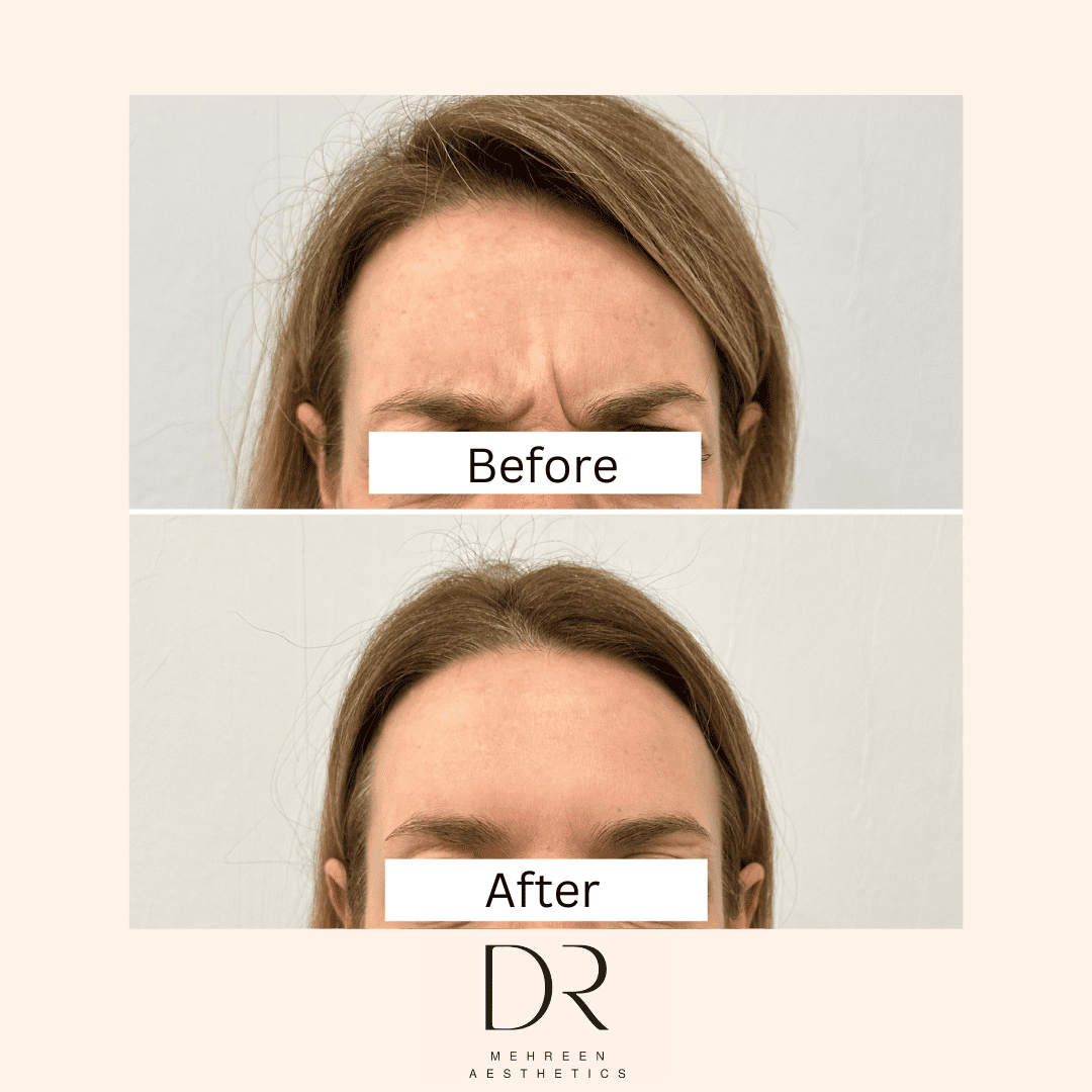 Antiwrinkle3