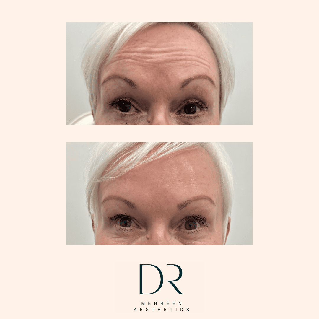 Antiwrinkle4