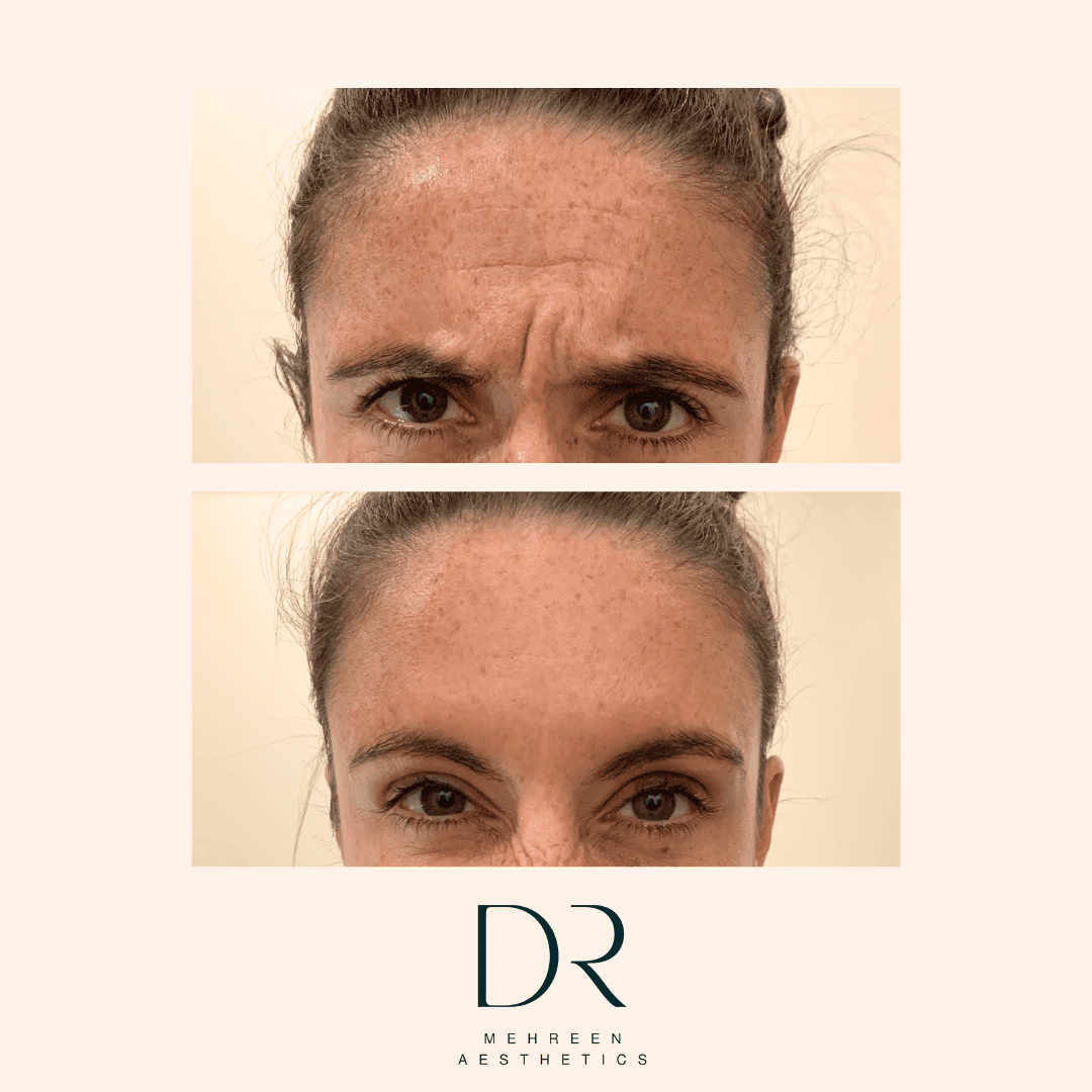 Antiwrinkle5