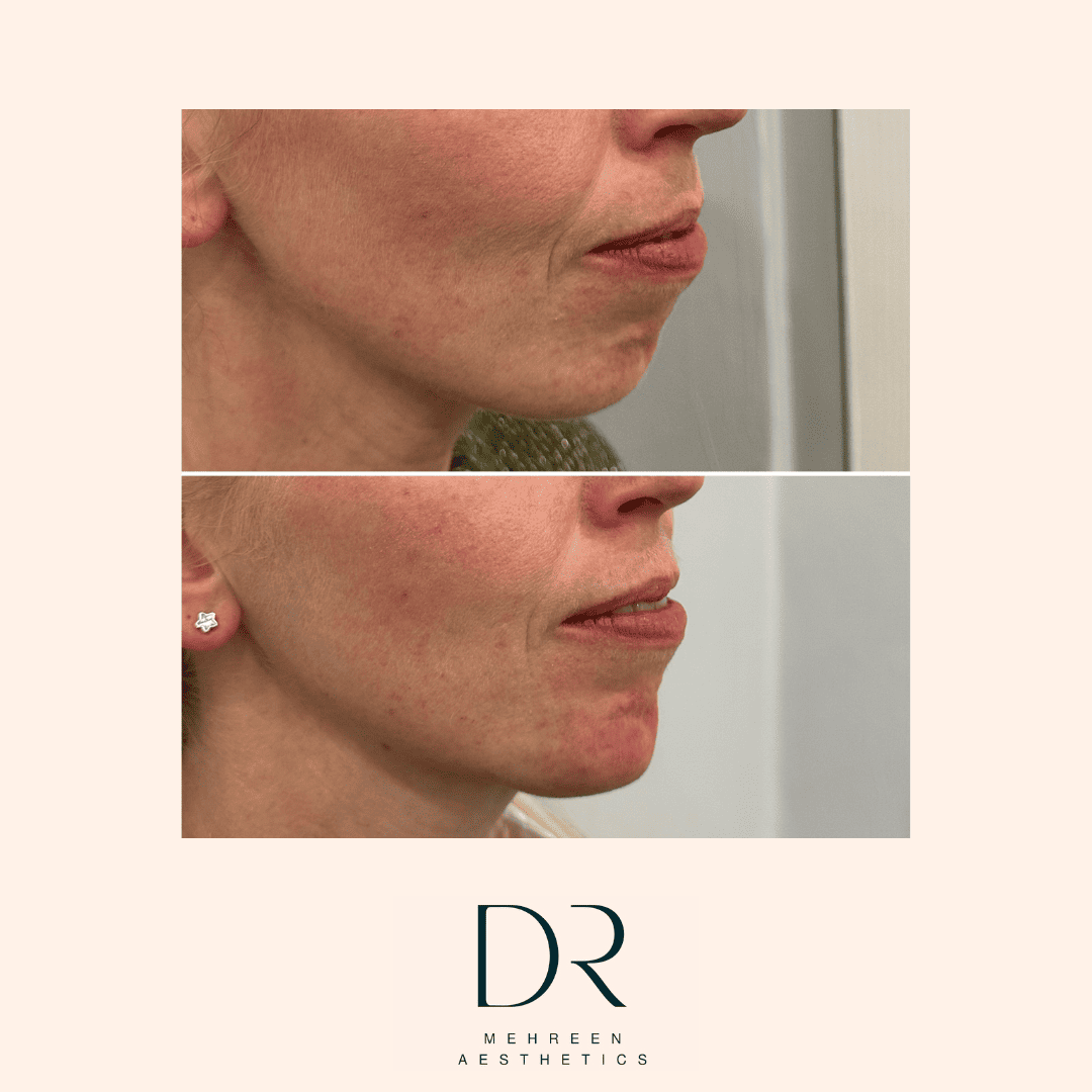 Dermal Filler 14.png