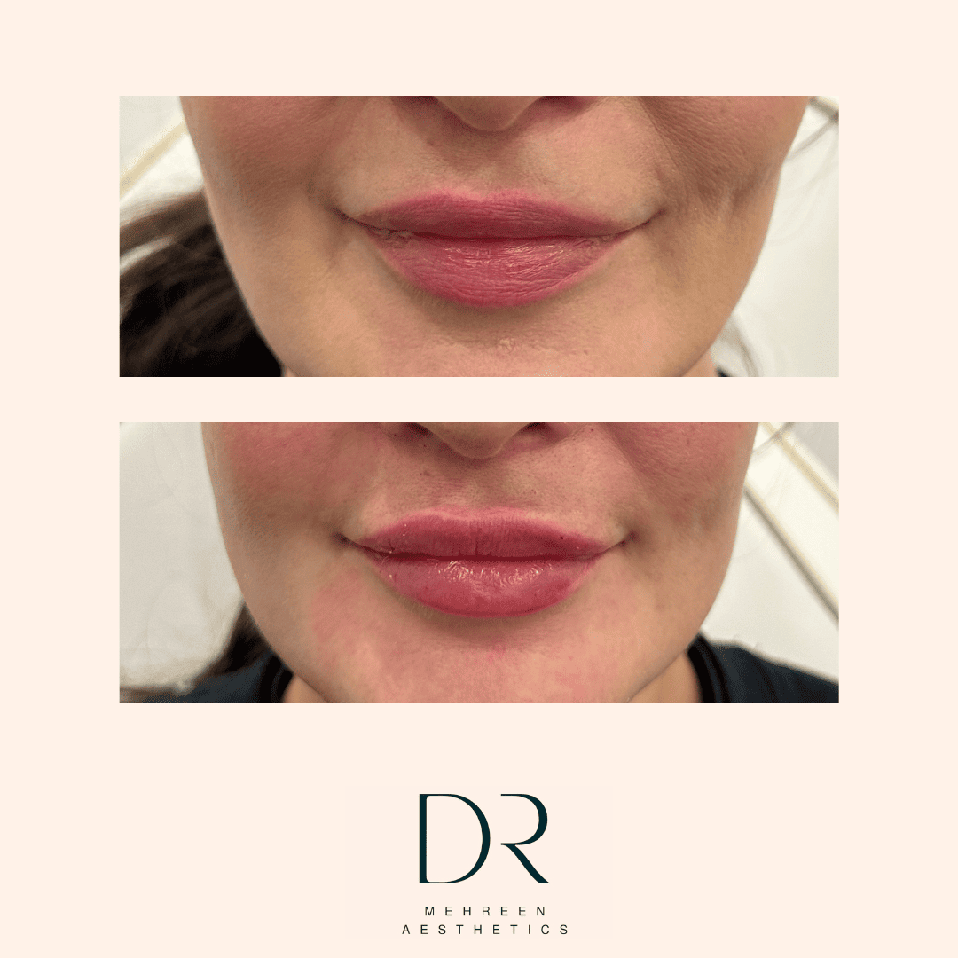 Dermal Filler 19.png