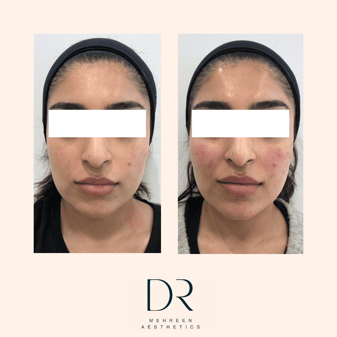Dermal Filler 2.png