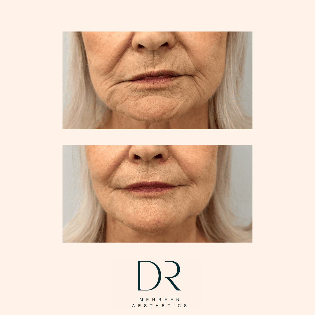 Dermal Filler 20.png
