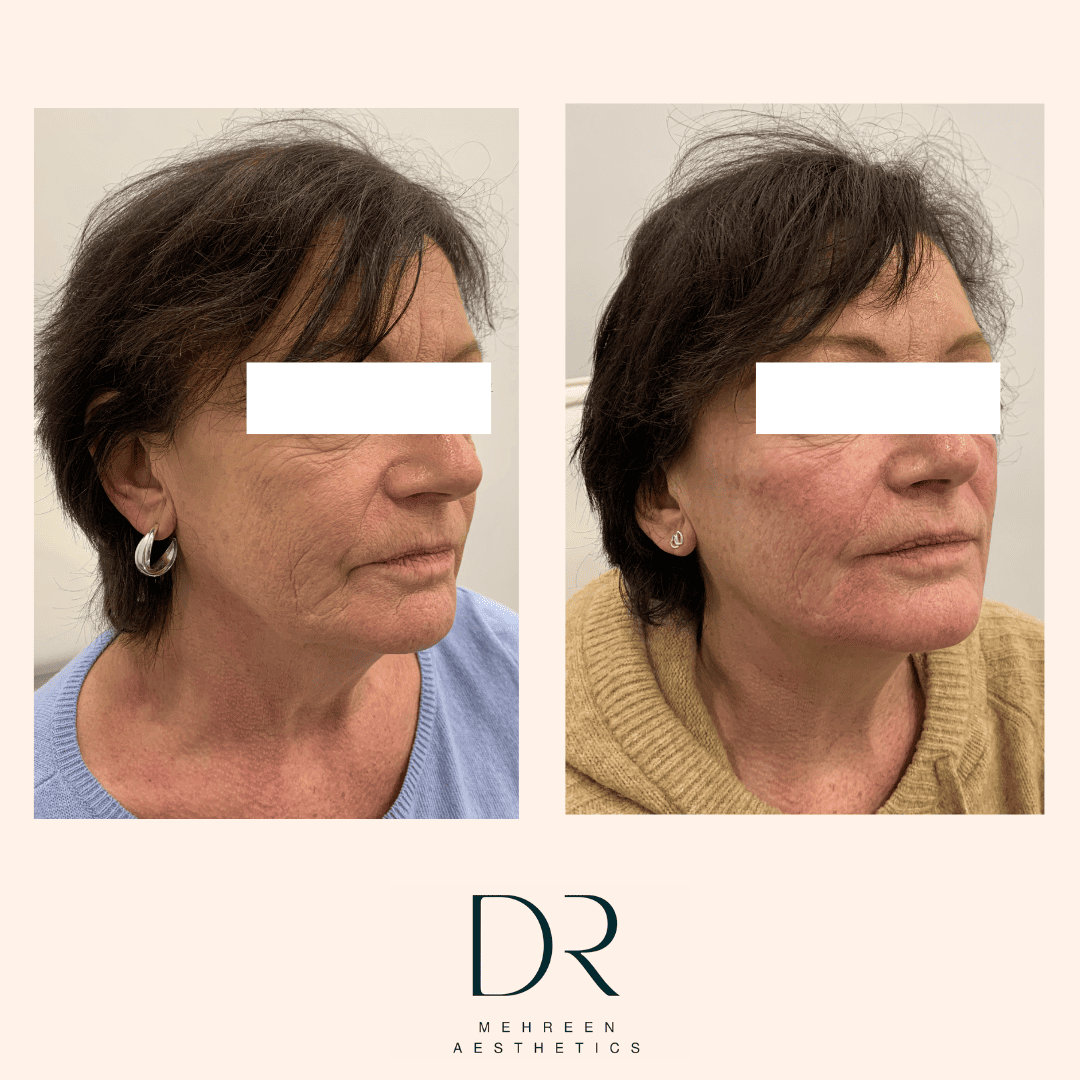 Dermal Filler 3.png