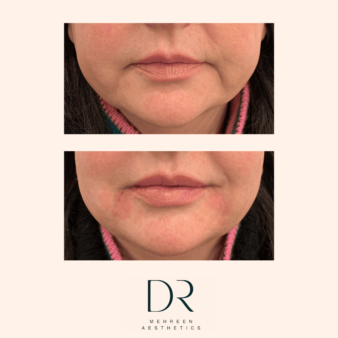 Dermal Filler 4.png