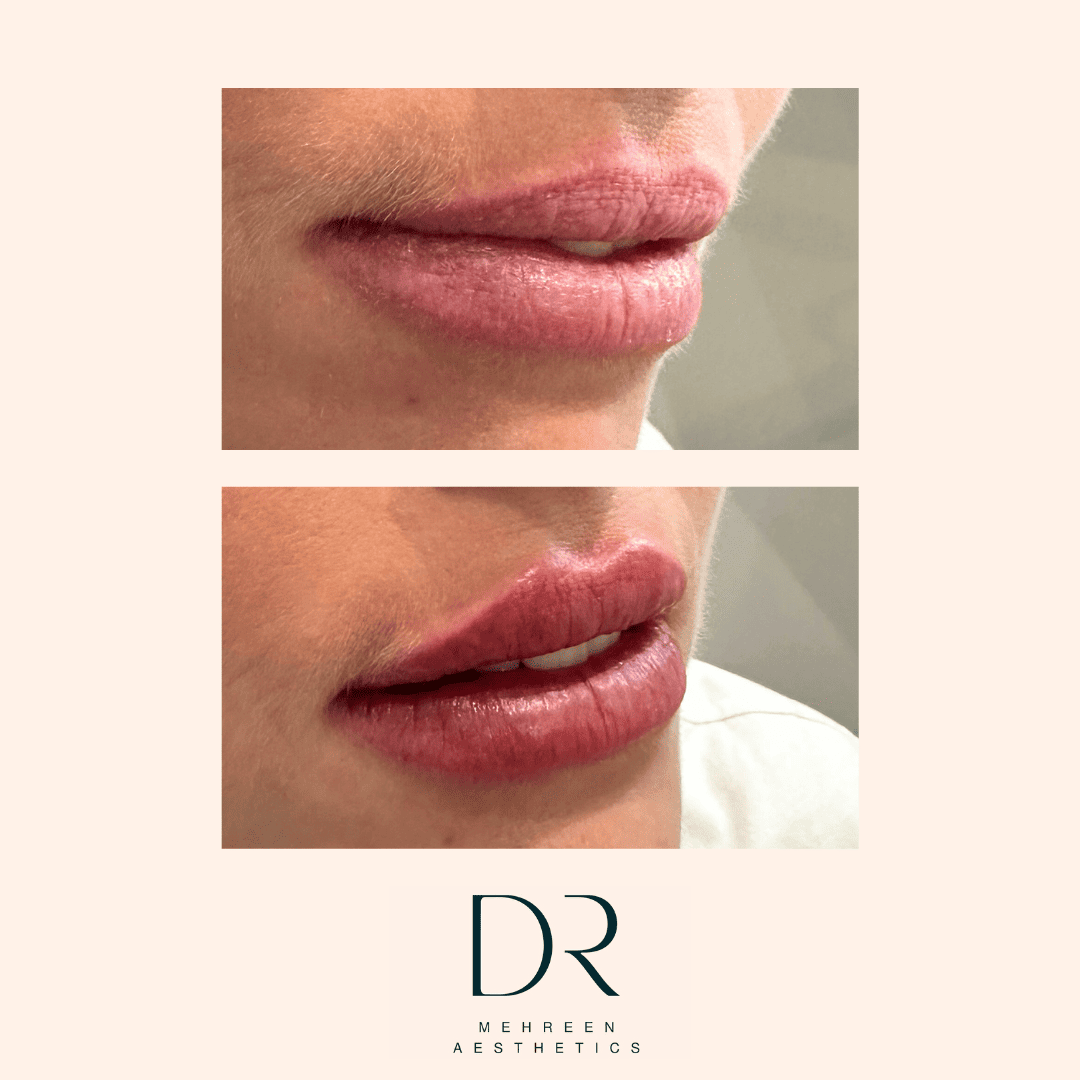 Lip filler